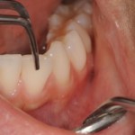 歯の動揺度２