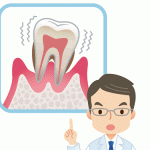 歯周病の原因と症状が現れる4つの組織について
