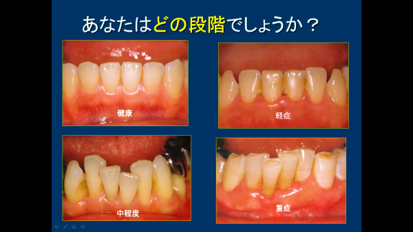 ①歯周病の段階